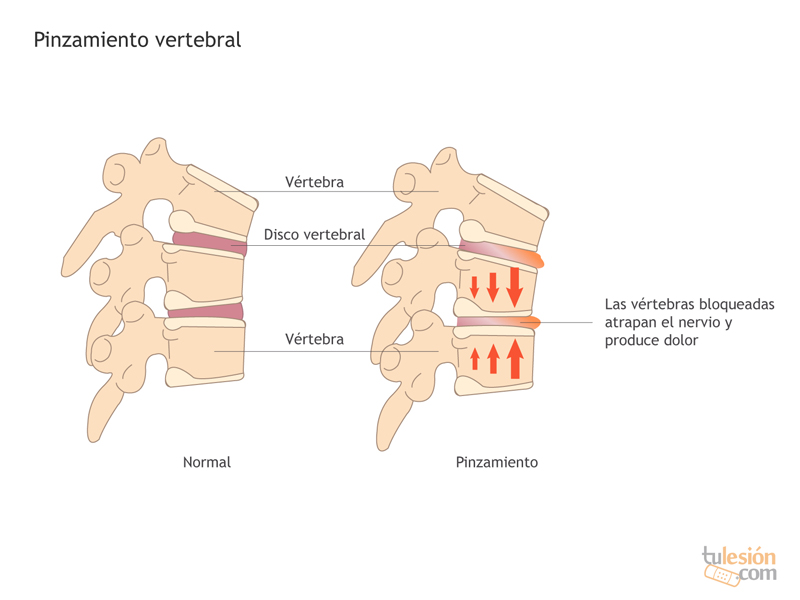 que es el pinzamiento lumbar